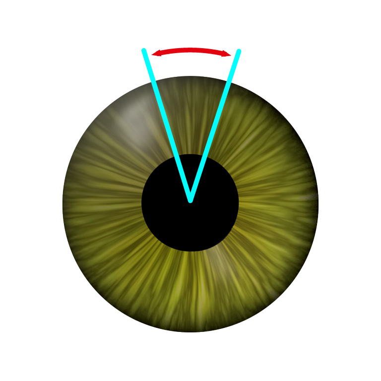 Cyclotorsion detection