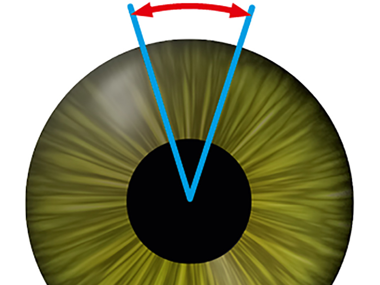 Cyclotorsion detection linking